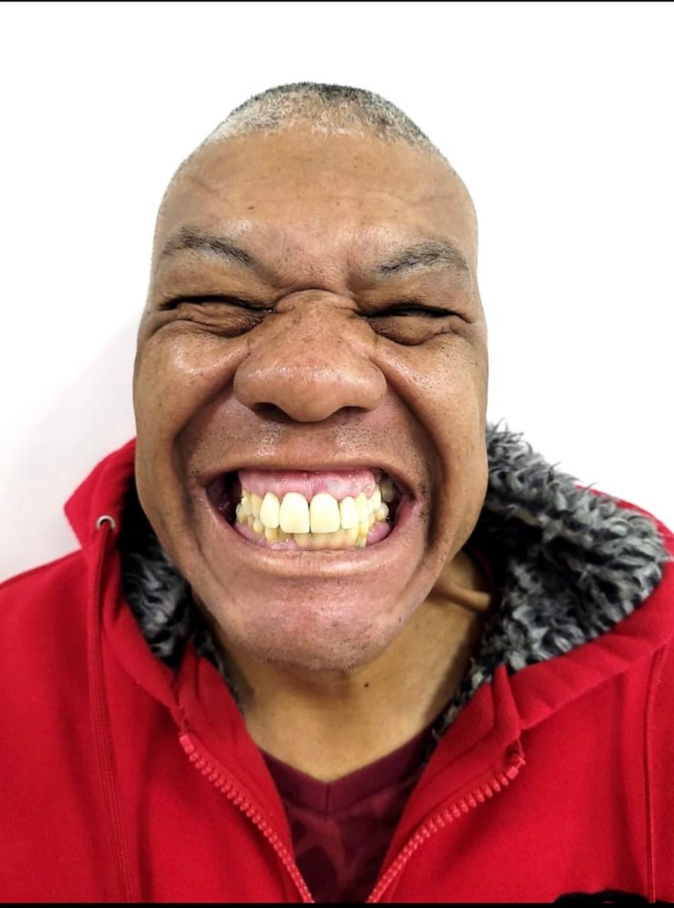 Antes do tratamento: Carlos com próteses antigas